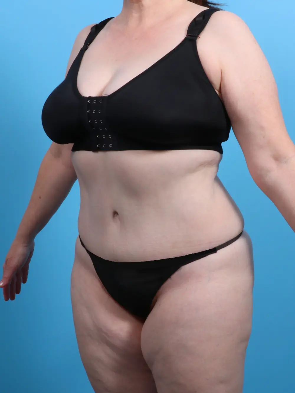 Tummy Tuck Patient Photo - Case 26252 - after view-1