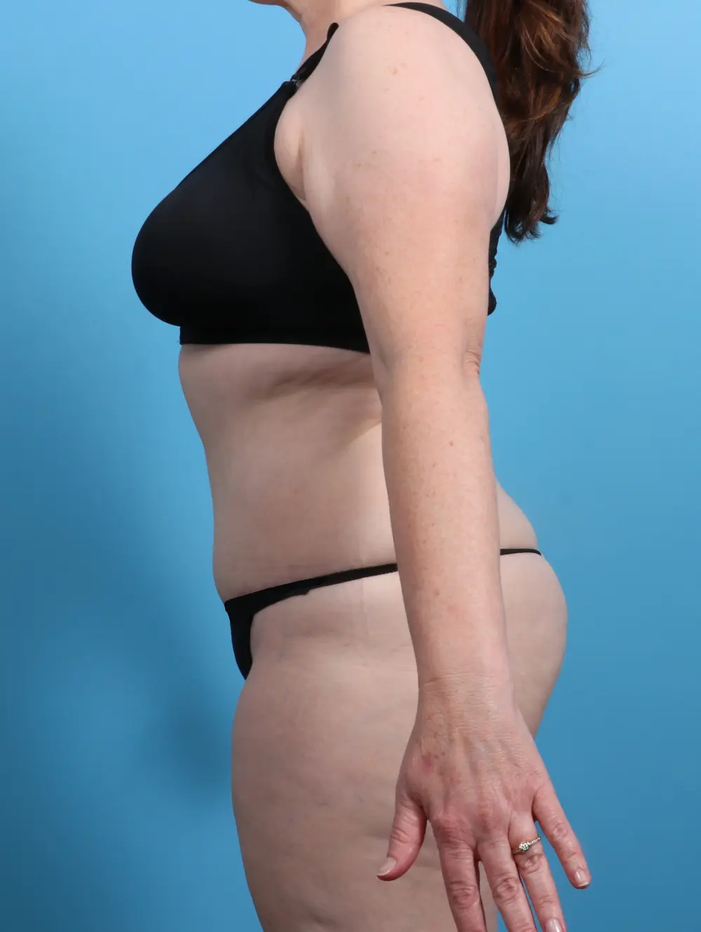 Tummy Tuck Patient Photo - Case 26252 - after view-2