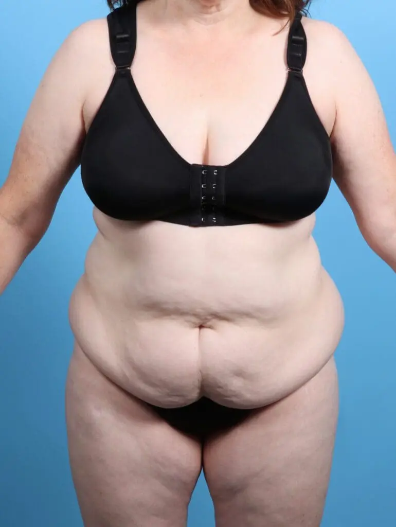 Tummy Tuck - Case 26252 - Before