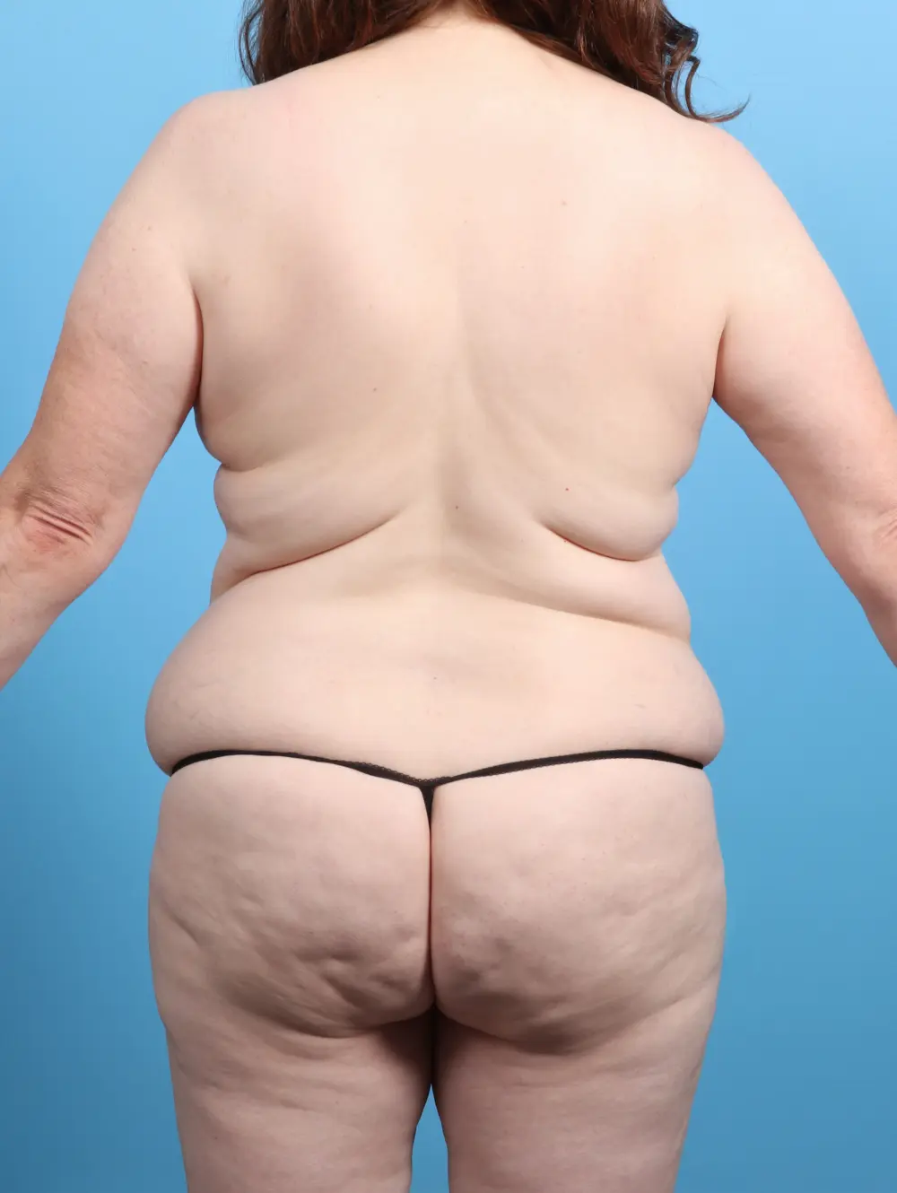 Tummy Tuck Patient Photo - Case 26252 - before view-3