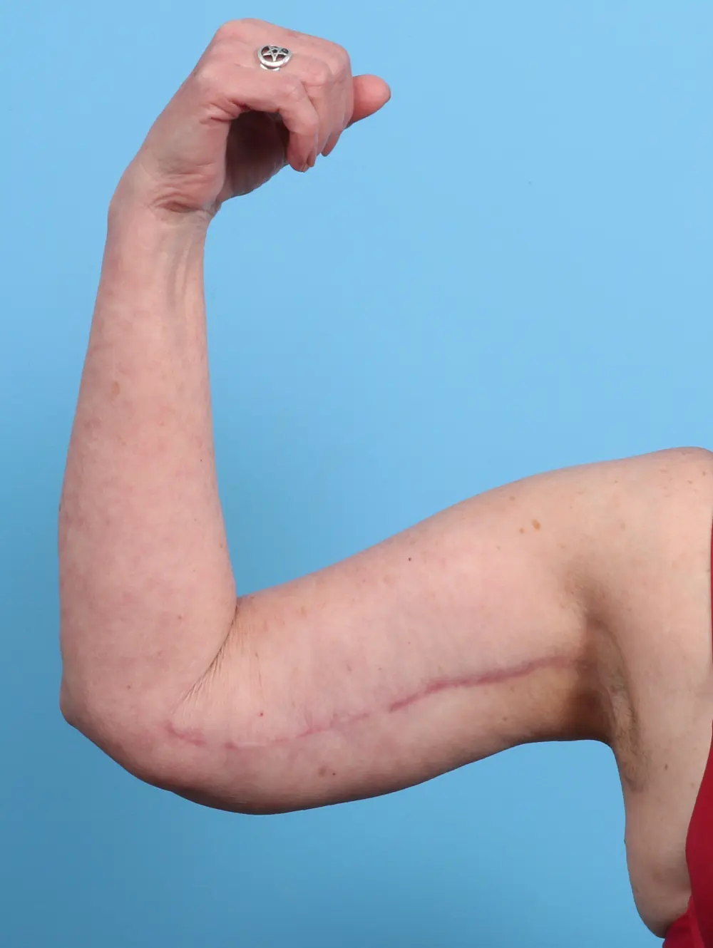 Arm Lift Patient Photo - Case 26262 - after view-1