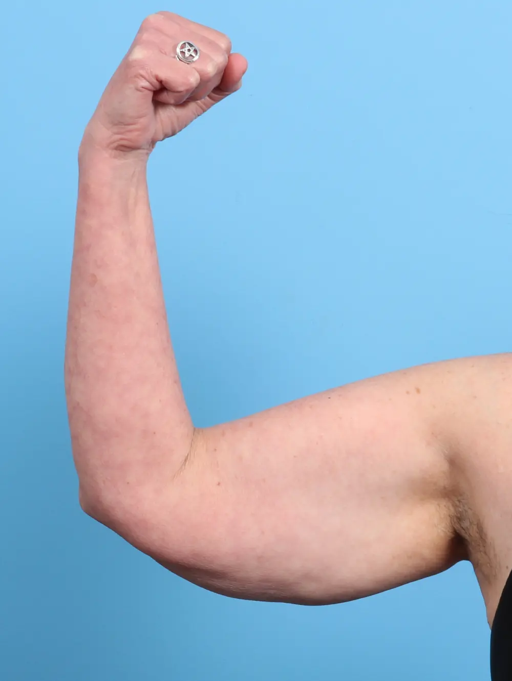 Arm Lift Patient Photo - Case 26262 - before view-1