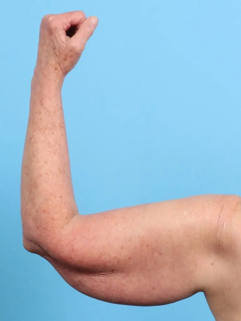 Arm Lift - Case 26262 - Before