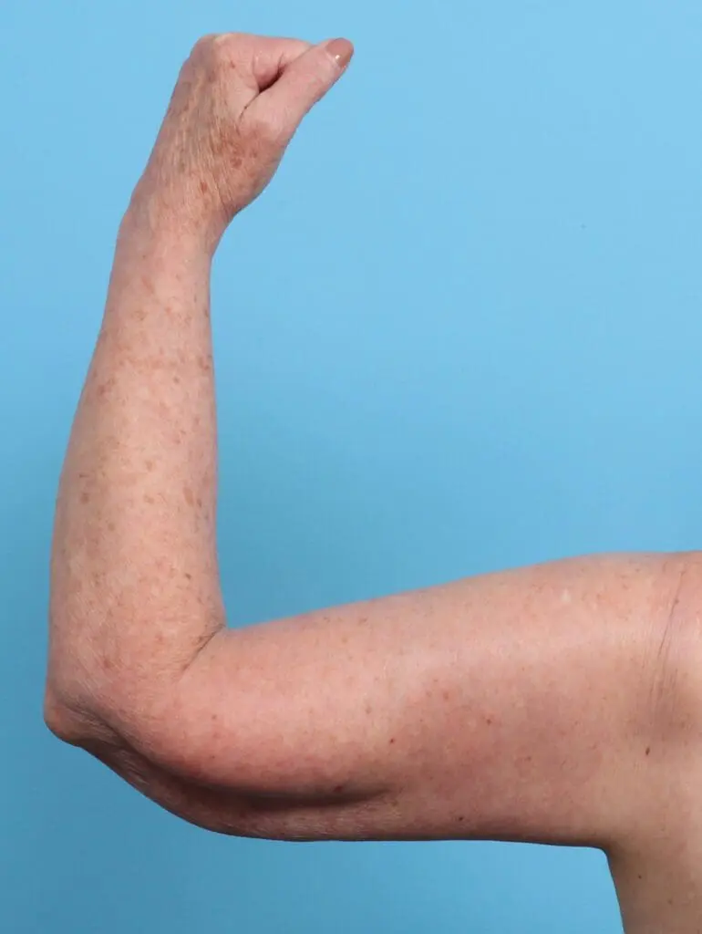 Arm Lift - Case 26262 - After