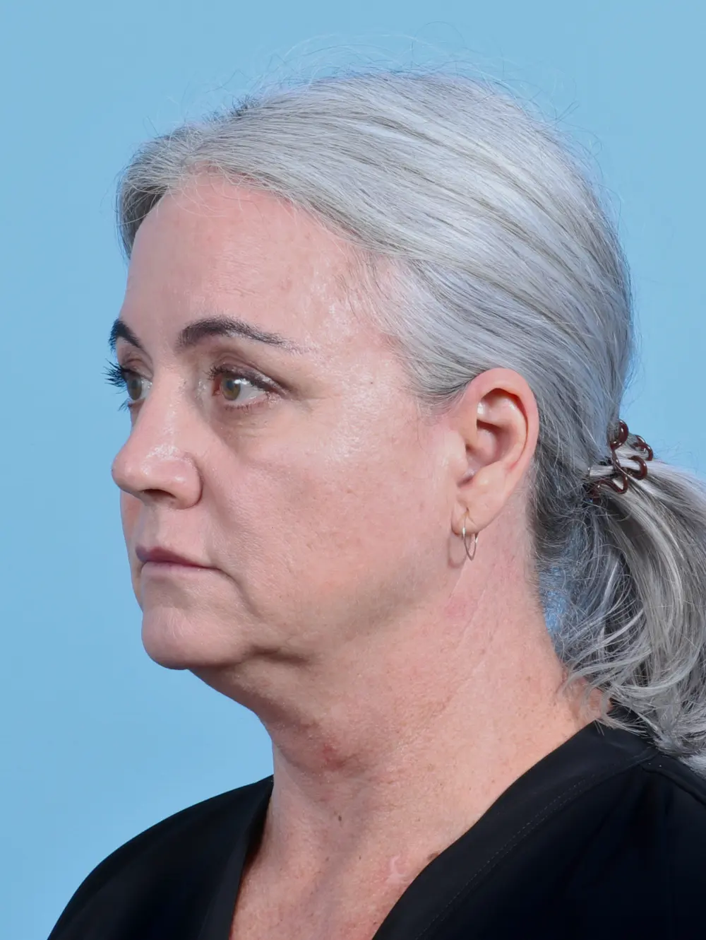 Facelift / Neck Lift Patient Photo - Case 26286 - before view-1