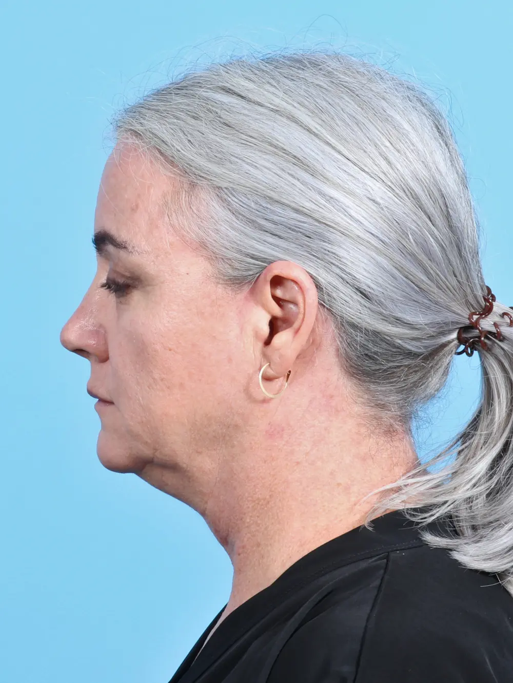 Facelift / Neck Lift Patient Photo - Case 26286 - before view-2