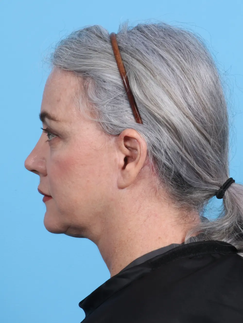 Facelift / Neck Lift Patient Photo - Case 26286 - after view-2