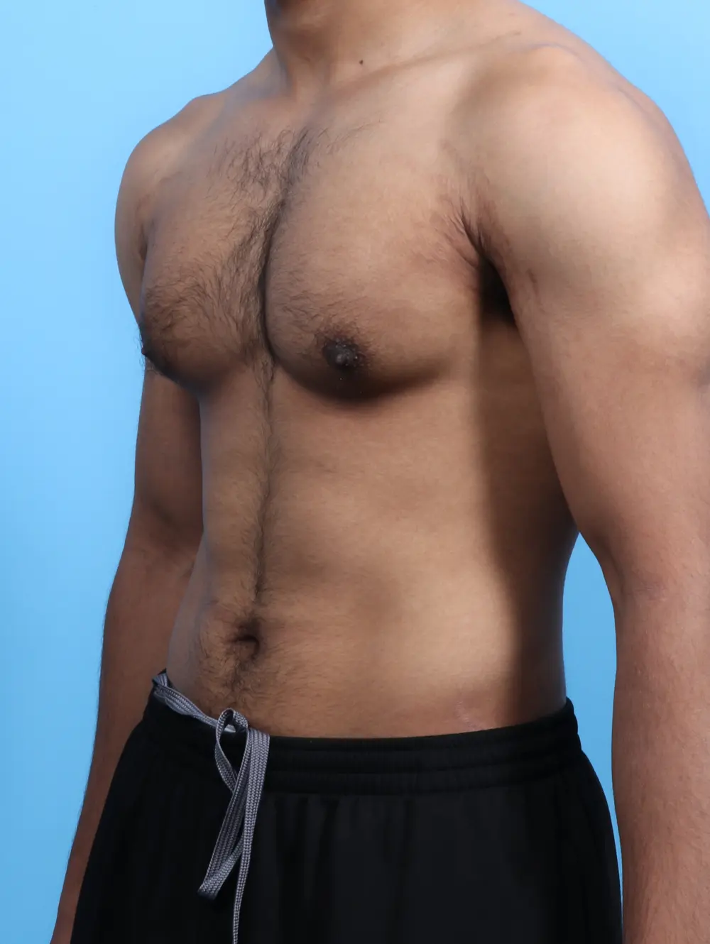 Gynecomastia Patient Photo - Case 26310 - before view-1