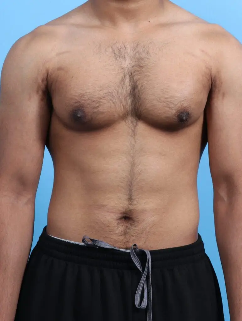 Gynecomastia - Case 26310 - Before