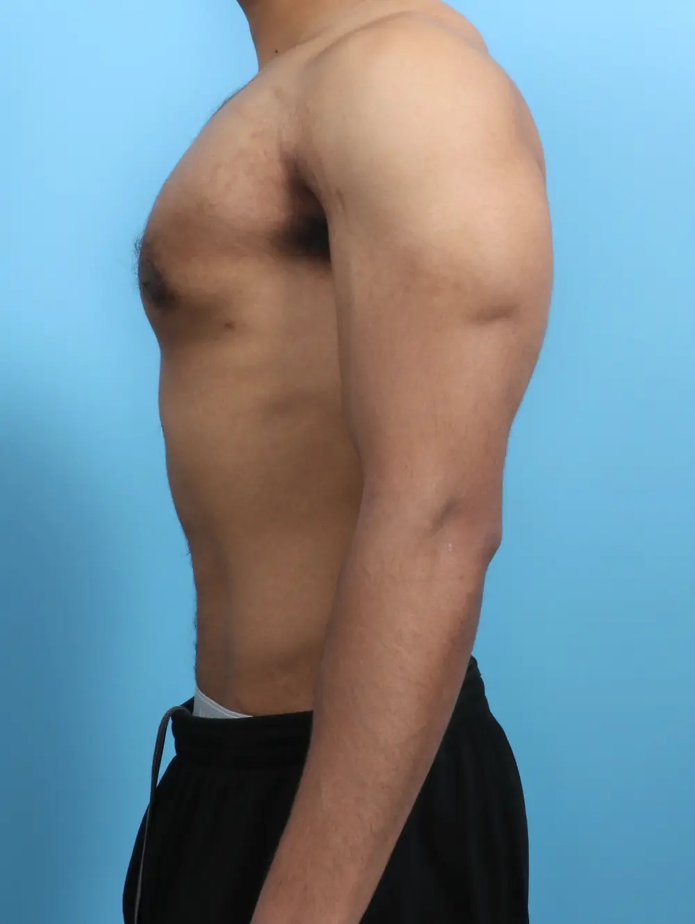 Gynecomastia Patient Photo - Case 26310 - after view-2