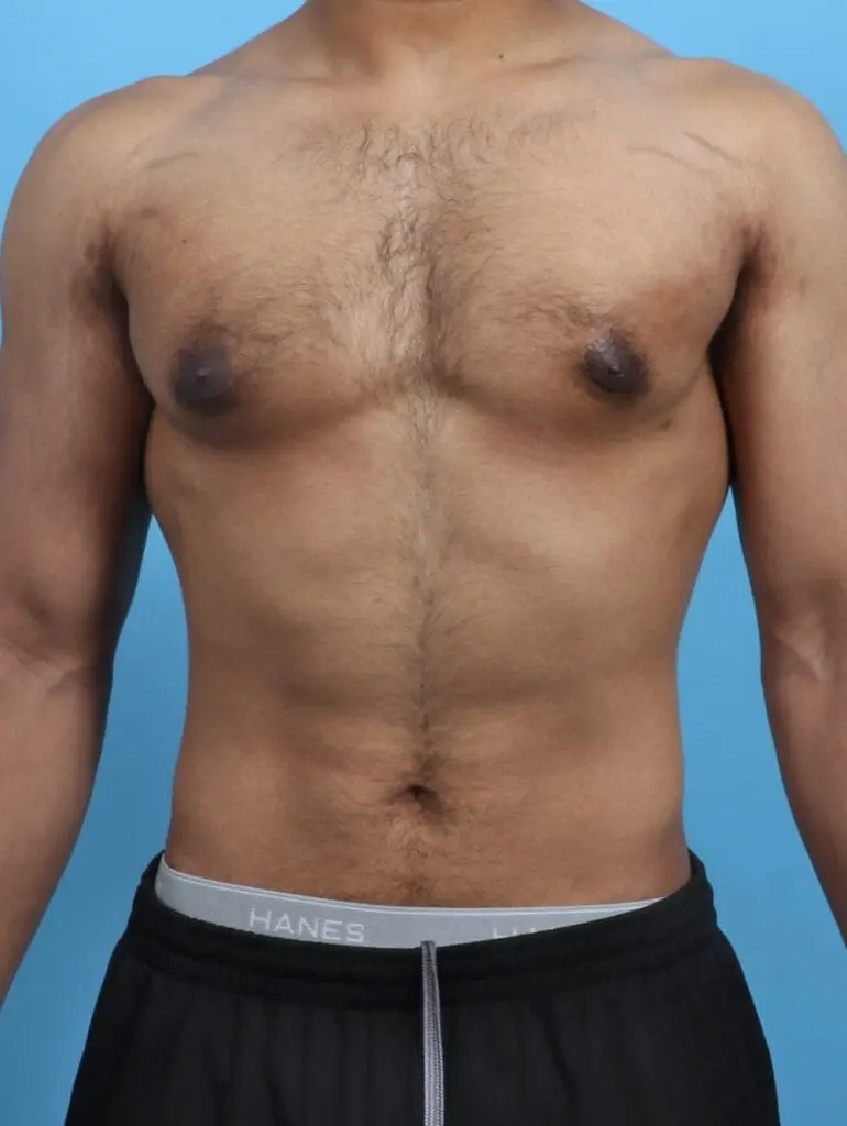 Gynecomastia - Case 26310 - After