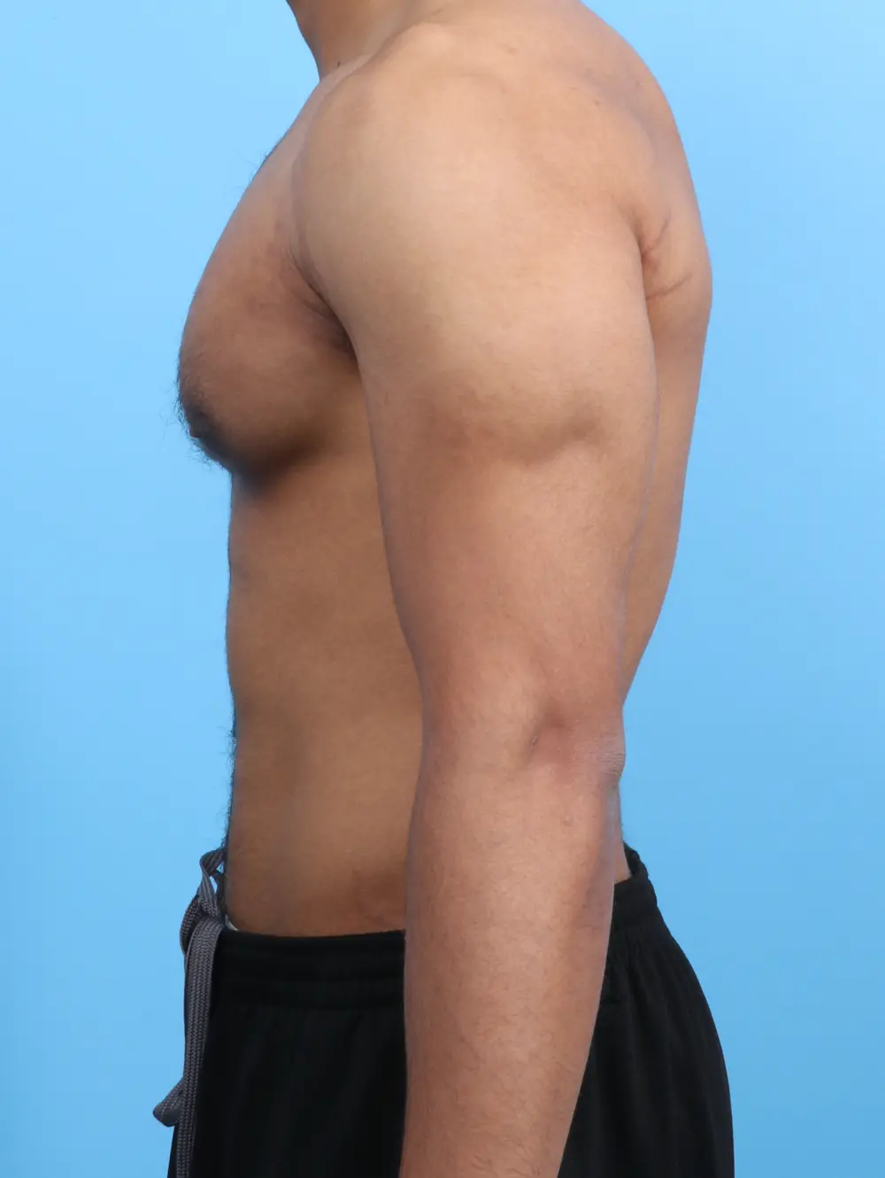 Gynecomastia Patient Photo - Case 26310 - before view-2