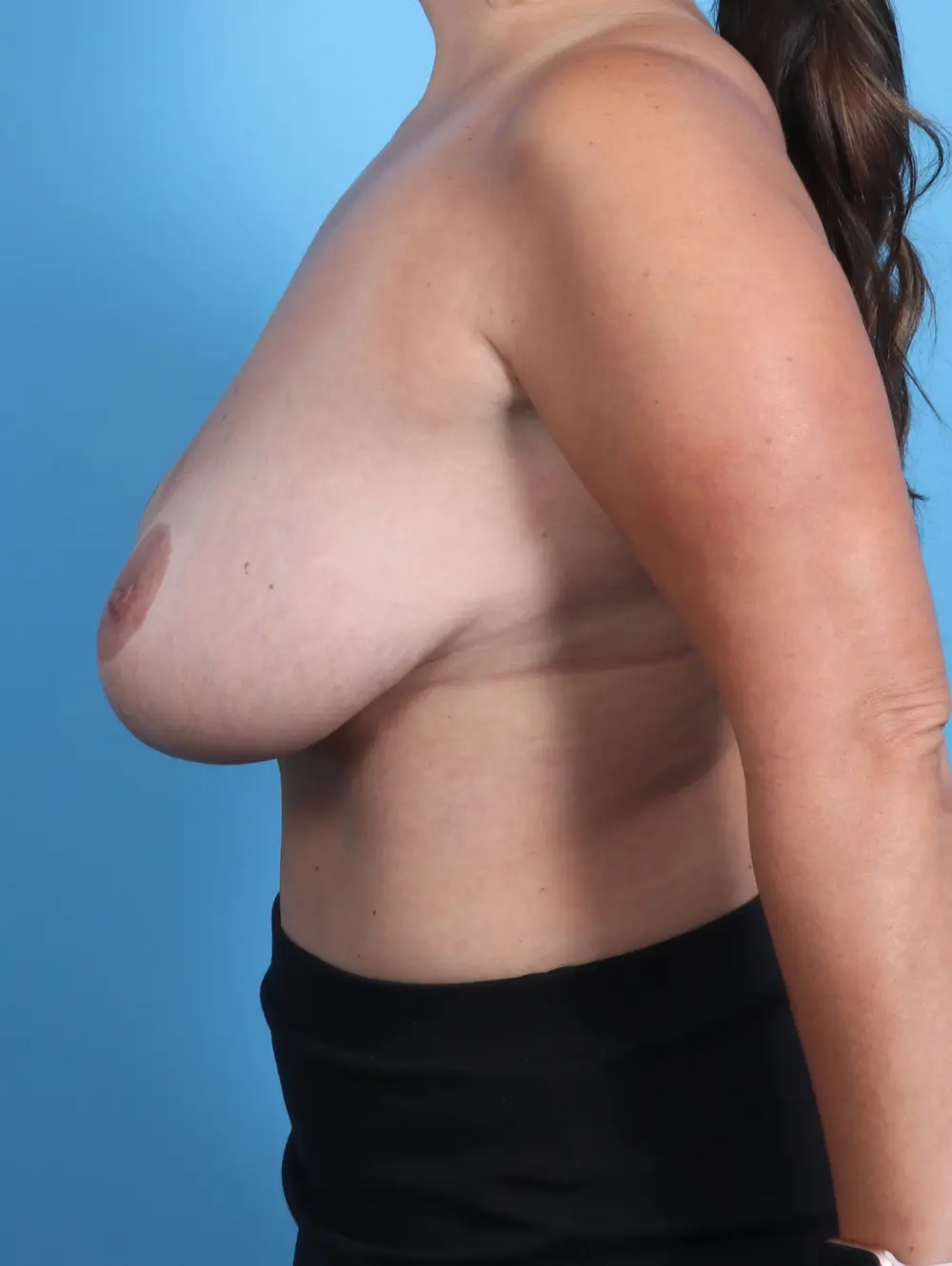 Breast Lift/Reduction with Implants Patient Photo - Case 26318 - before view-2