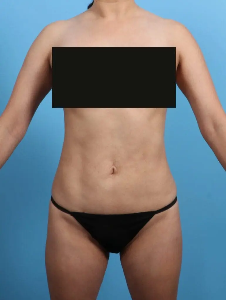 Liposuction - Case 26326 - After