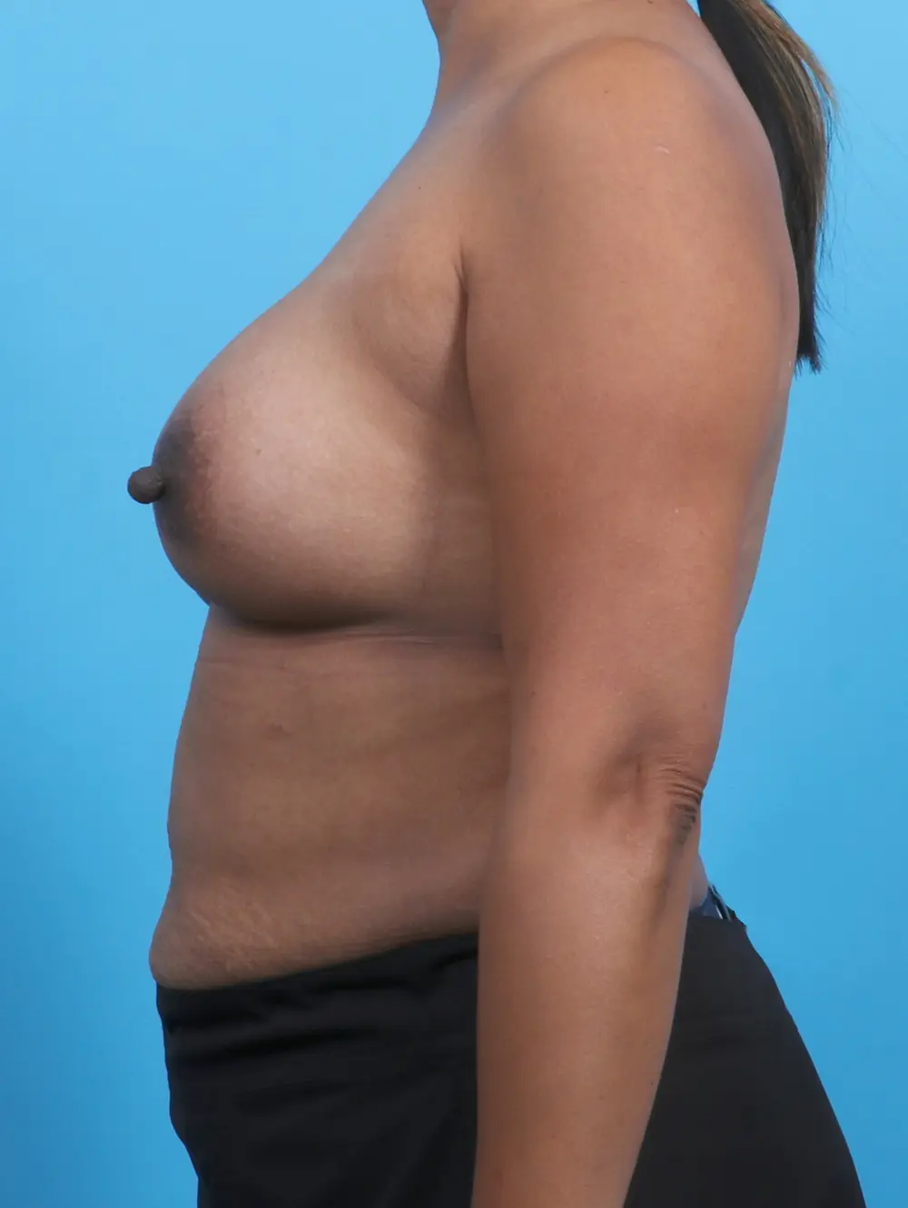 Breast Implant Revision Patient Photo - Case 26372 - after view-2