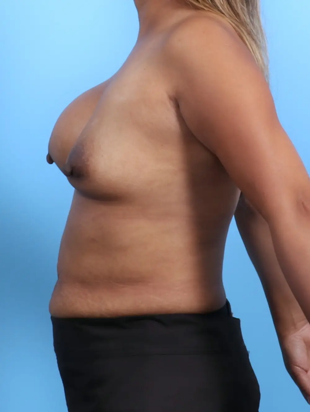Breast Implant Revision Patient Photo - Case 26372 - before view-2