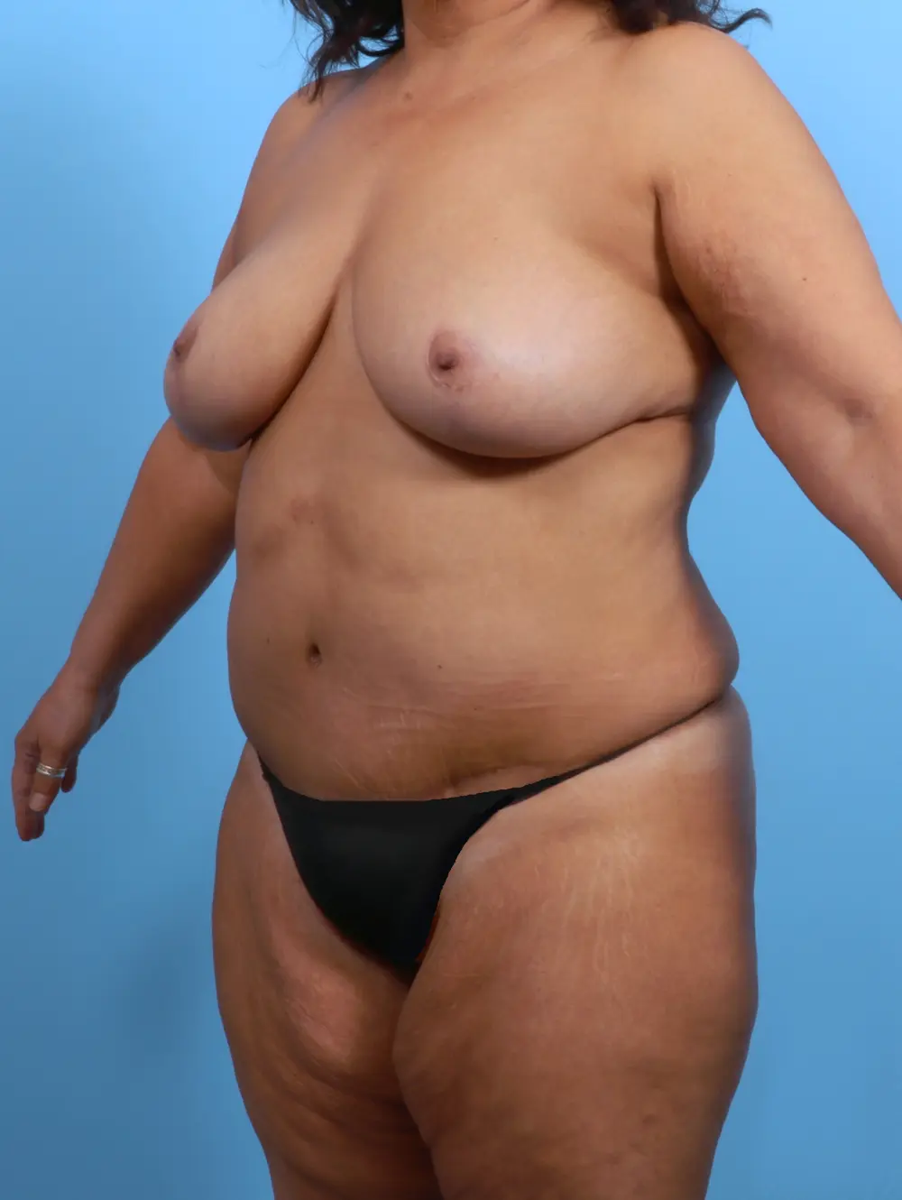 Breast Lift/Reduction w/o Implants Patient Photo - Case 26381 - after view-1