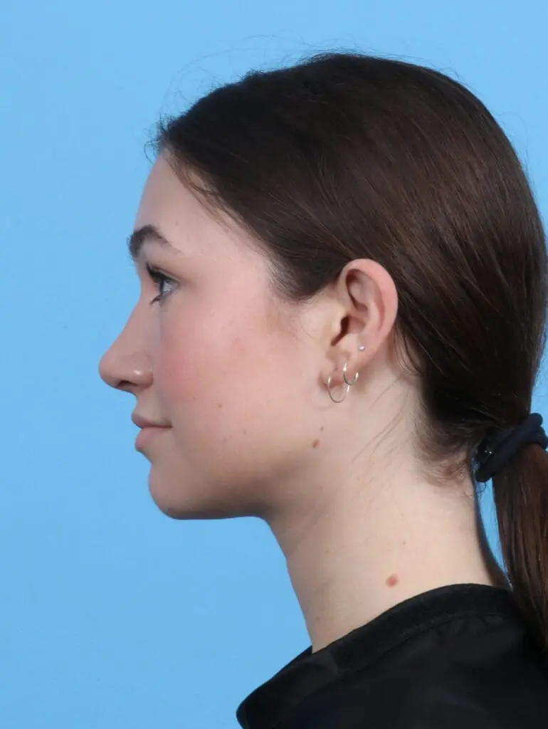 Rhinoplasty - Case 26414 - After