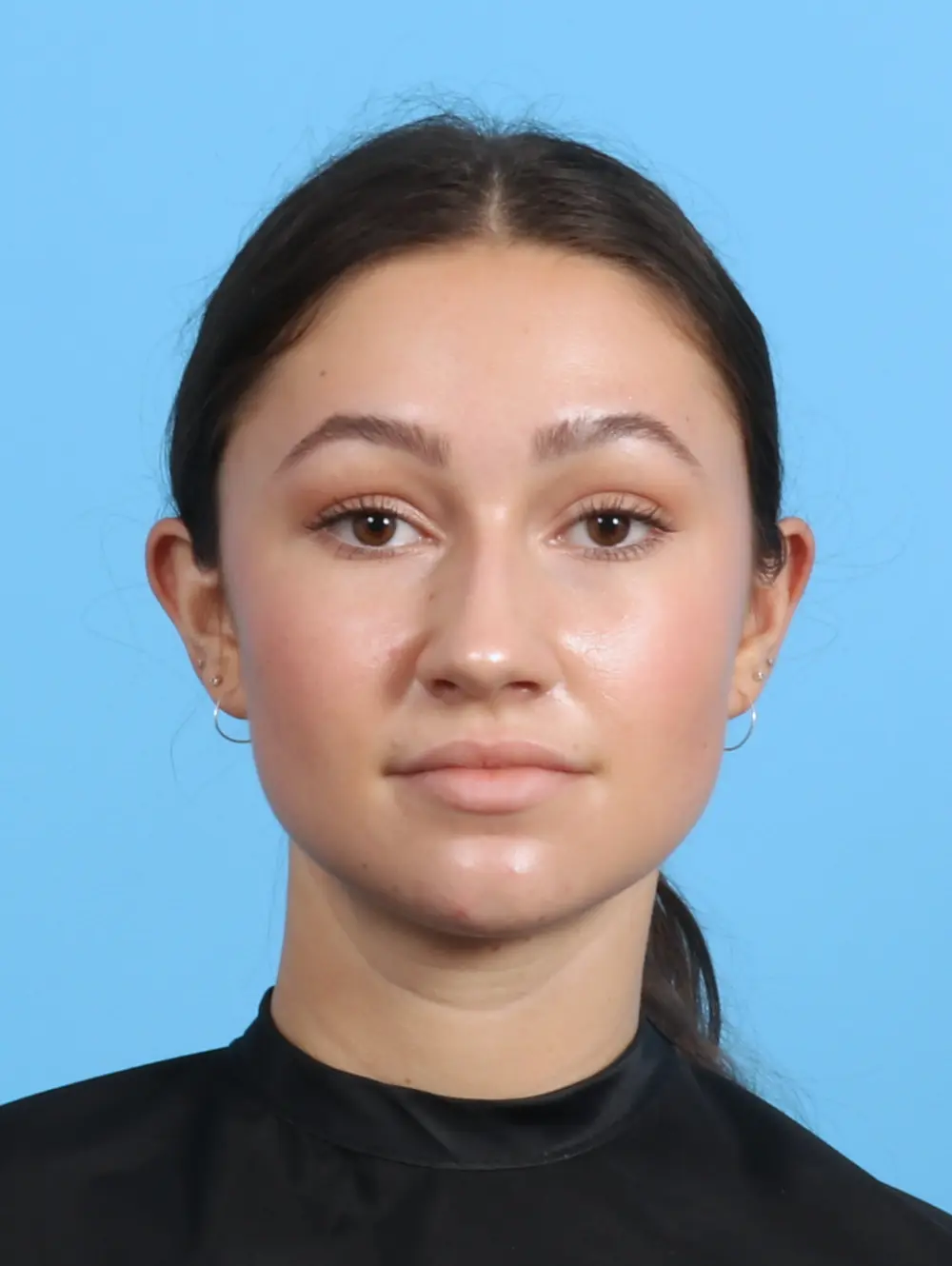 Rhinoplasty Patient Photo - Case 26414 - before view-2