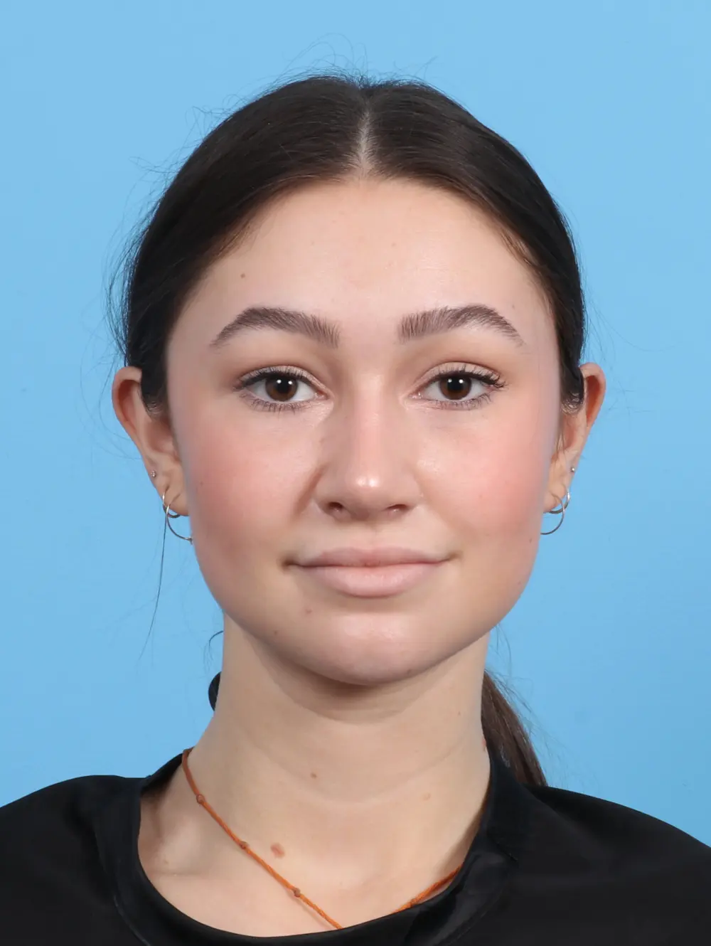 Rhinoplasty Patient Photo - Case 26414 - after view-2