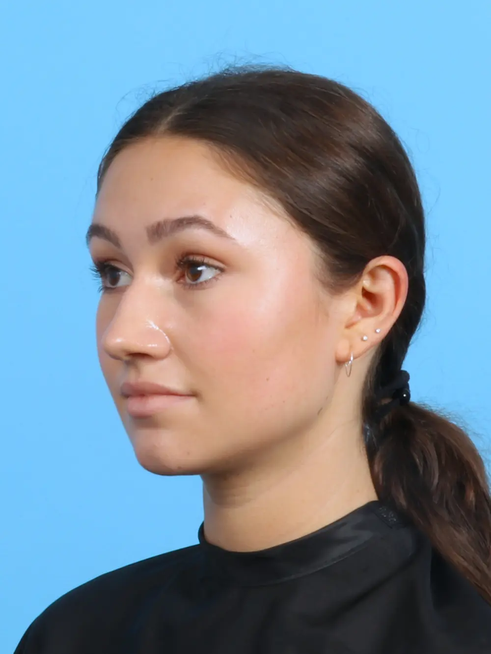 Rhinoplasty Patient Photo - Case 26414 - before view-1