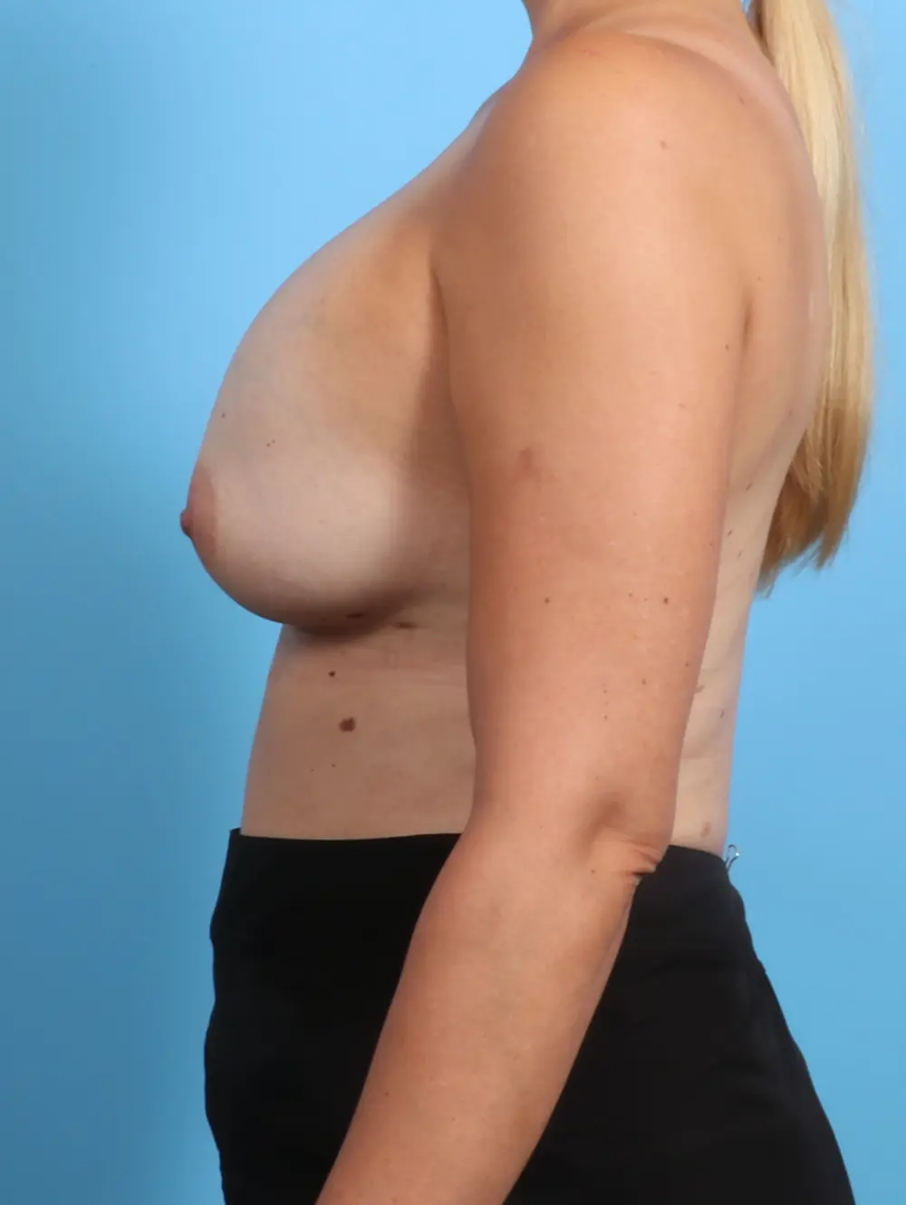 Breast Implant Revision Patient Photo - Case 26430 - before view-2