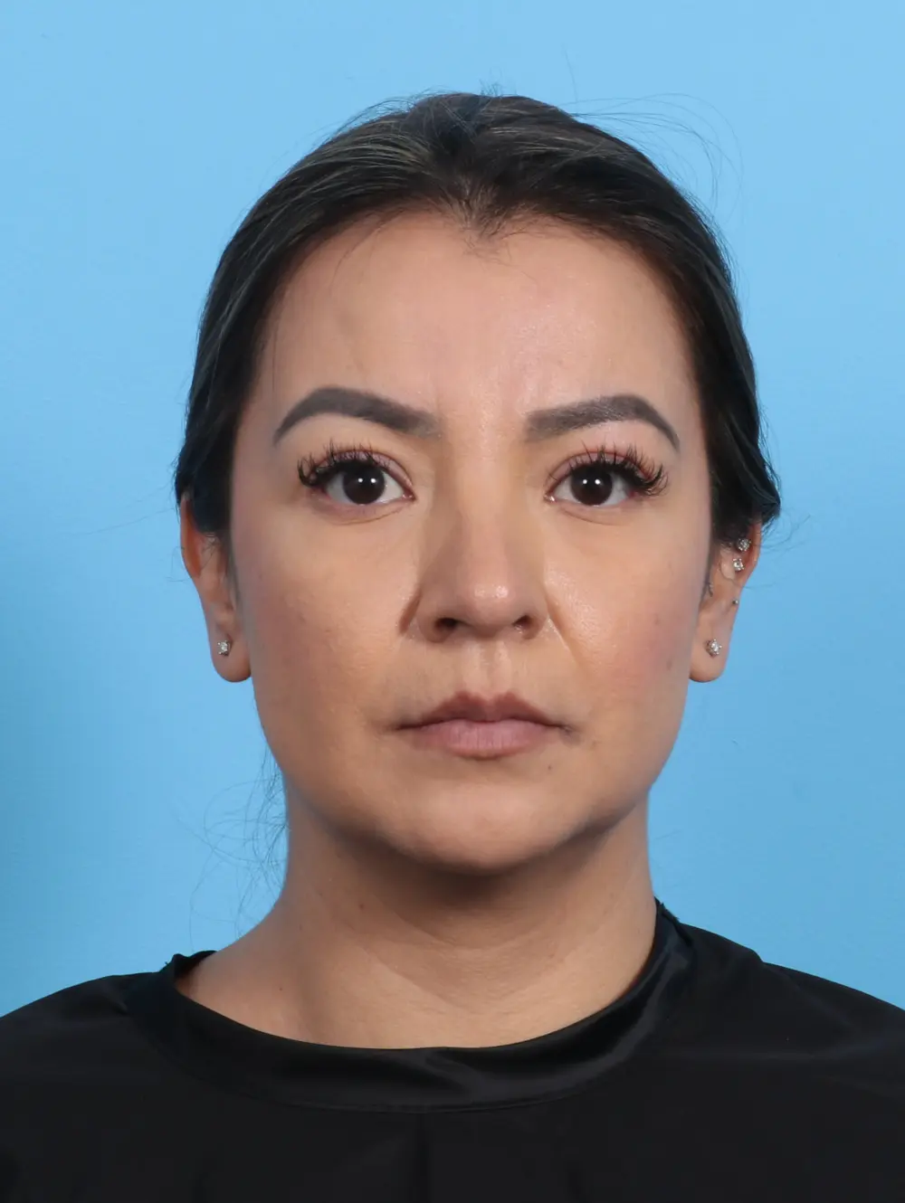 Rhinoplasty Patient Photo - Case 26470 - after view-2