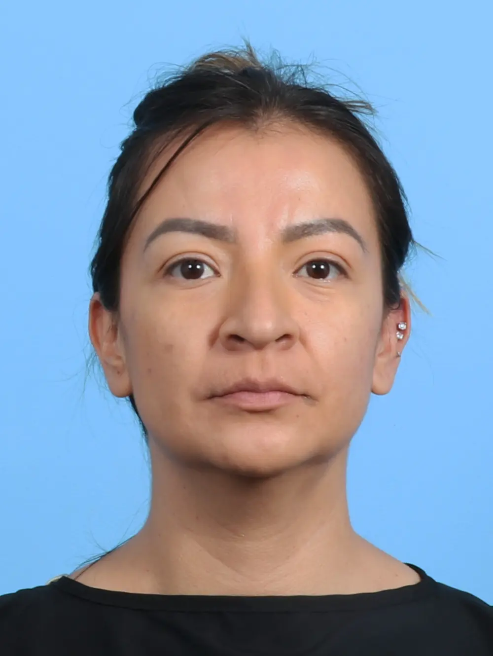 Rhinoplasty Patient Photo - Case 26470 - before view-2