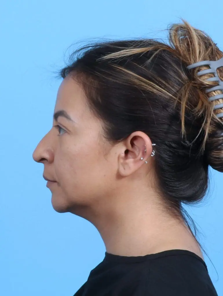 Rhinoplasty - Case 26470 - Before