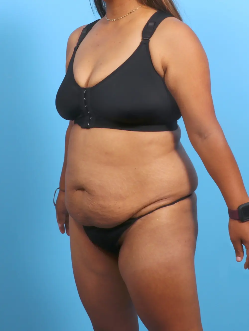 Tummy Tuck Patient Photo - Case 26486 - before view-1