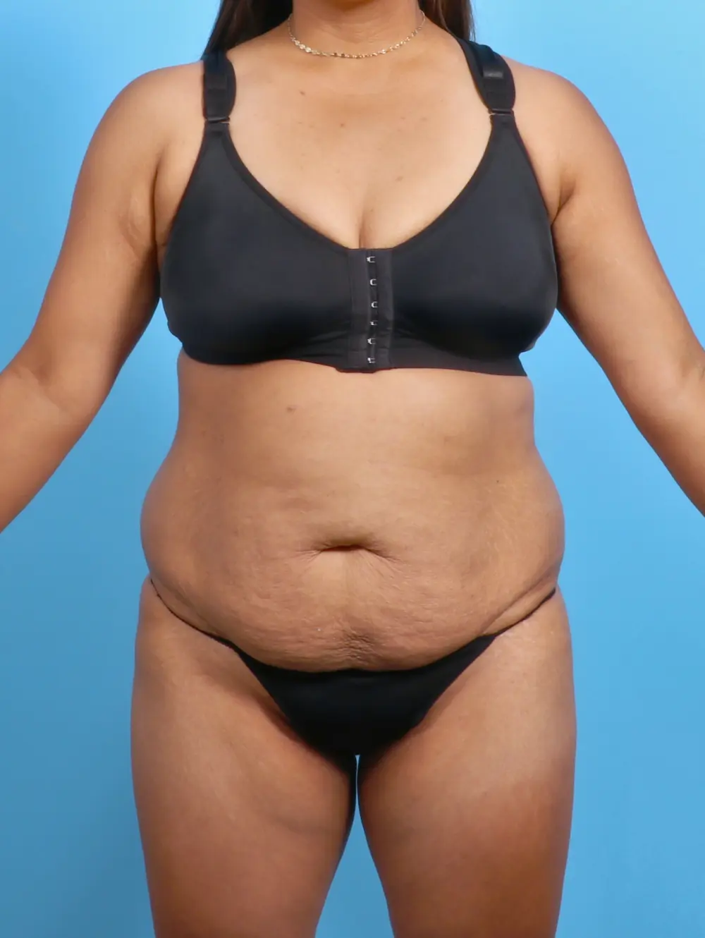 Tummy Tuck Patient Photo - Case 26486 - before view-
