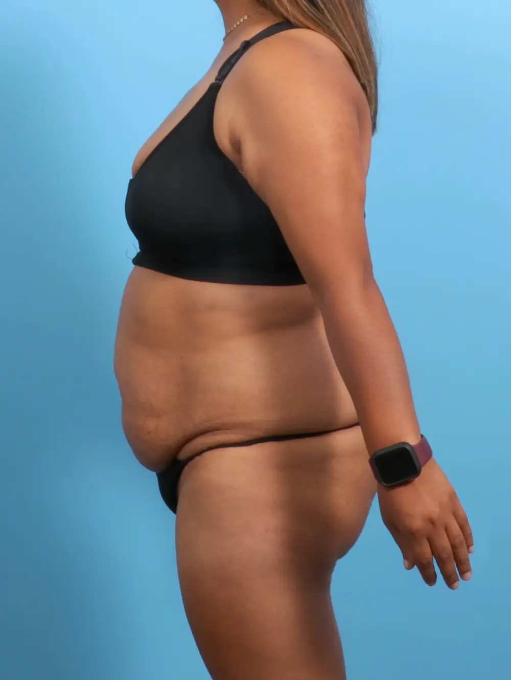 Tummy Tuck Patient Photo - Case 26486 - before view-2