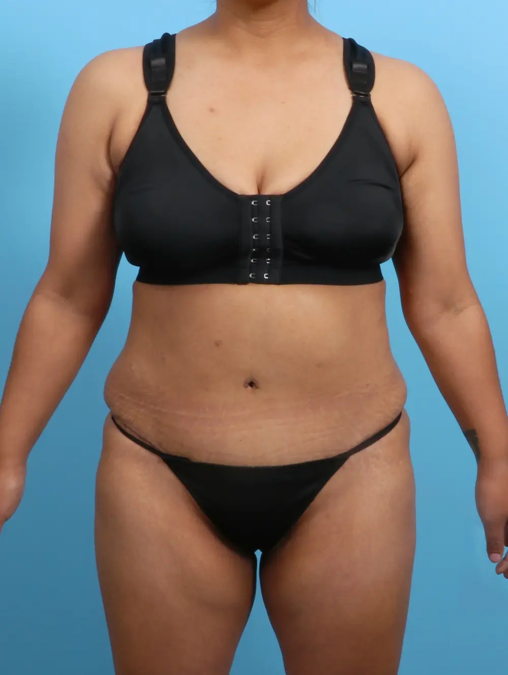 Tummy Tuck Patient Photo - Case 26486 - after view