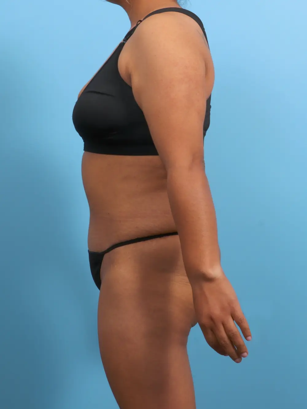 Tummy Tuck Patient Photo - Case 26486 - after view-2