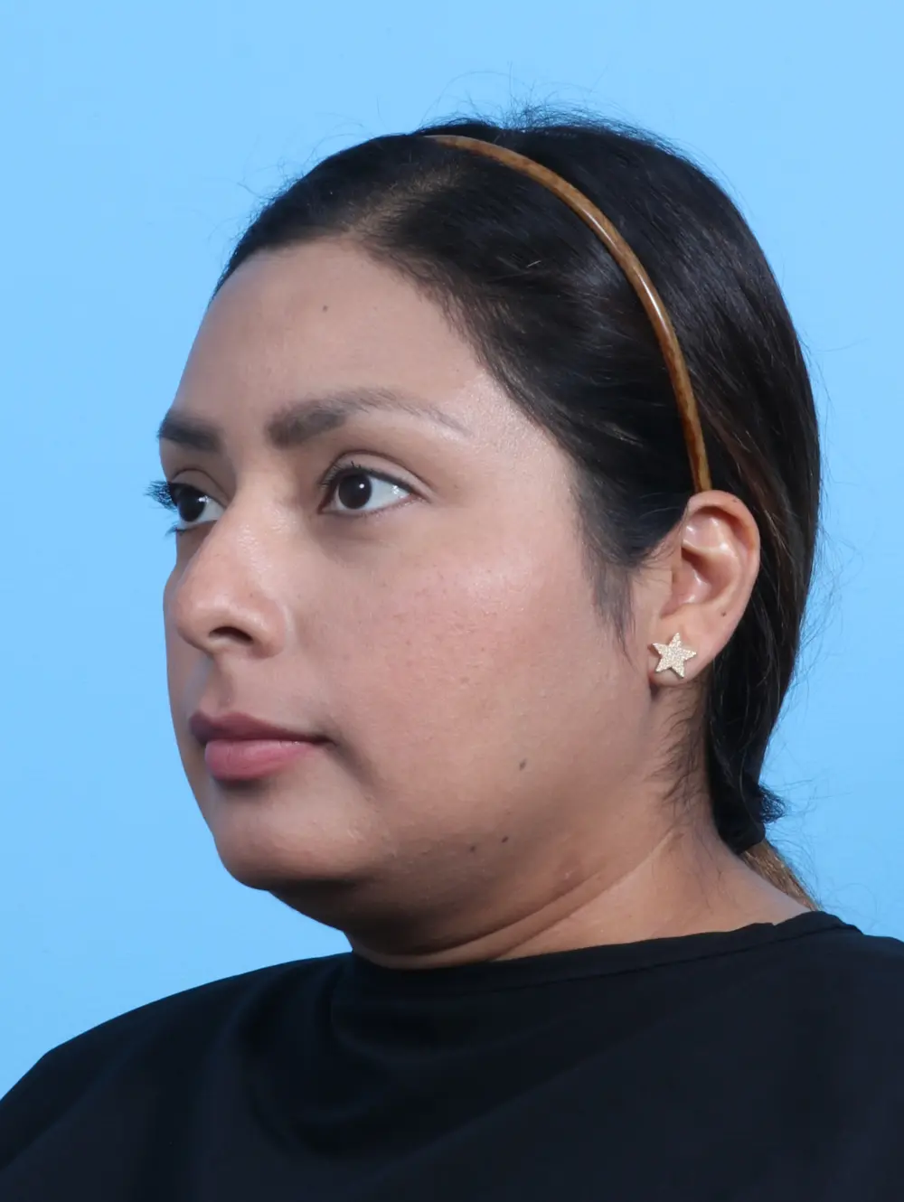 Rhinoplasty Patient Photo - Case 26494 - before view-1