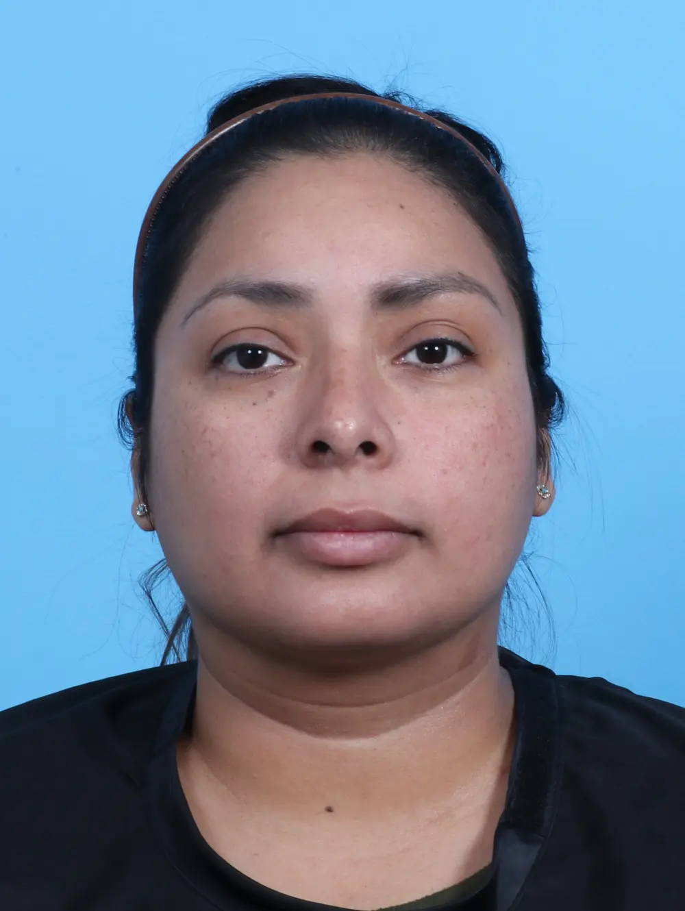 Rhinoplasty Patient Photo - Case 26494 - after view-2