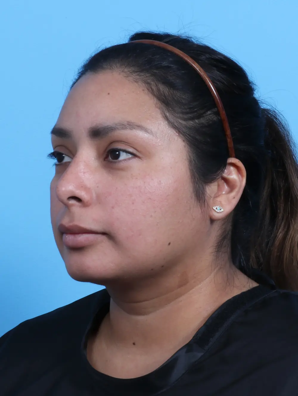 Rhinoplasty Patient Photo - Case 26494 - after view-1