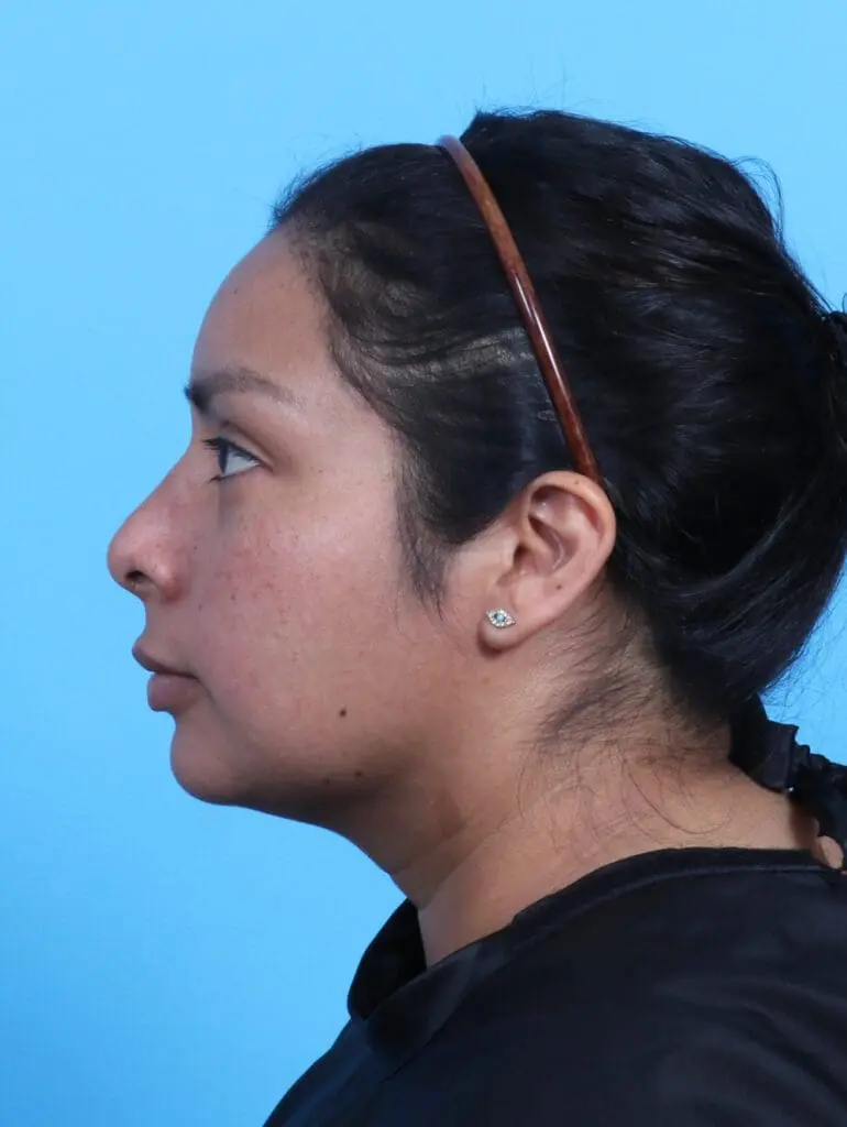 Rhinoplasty - Case 26494 - After