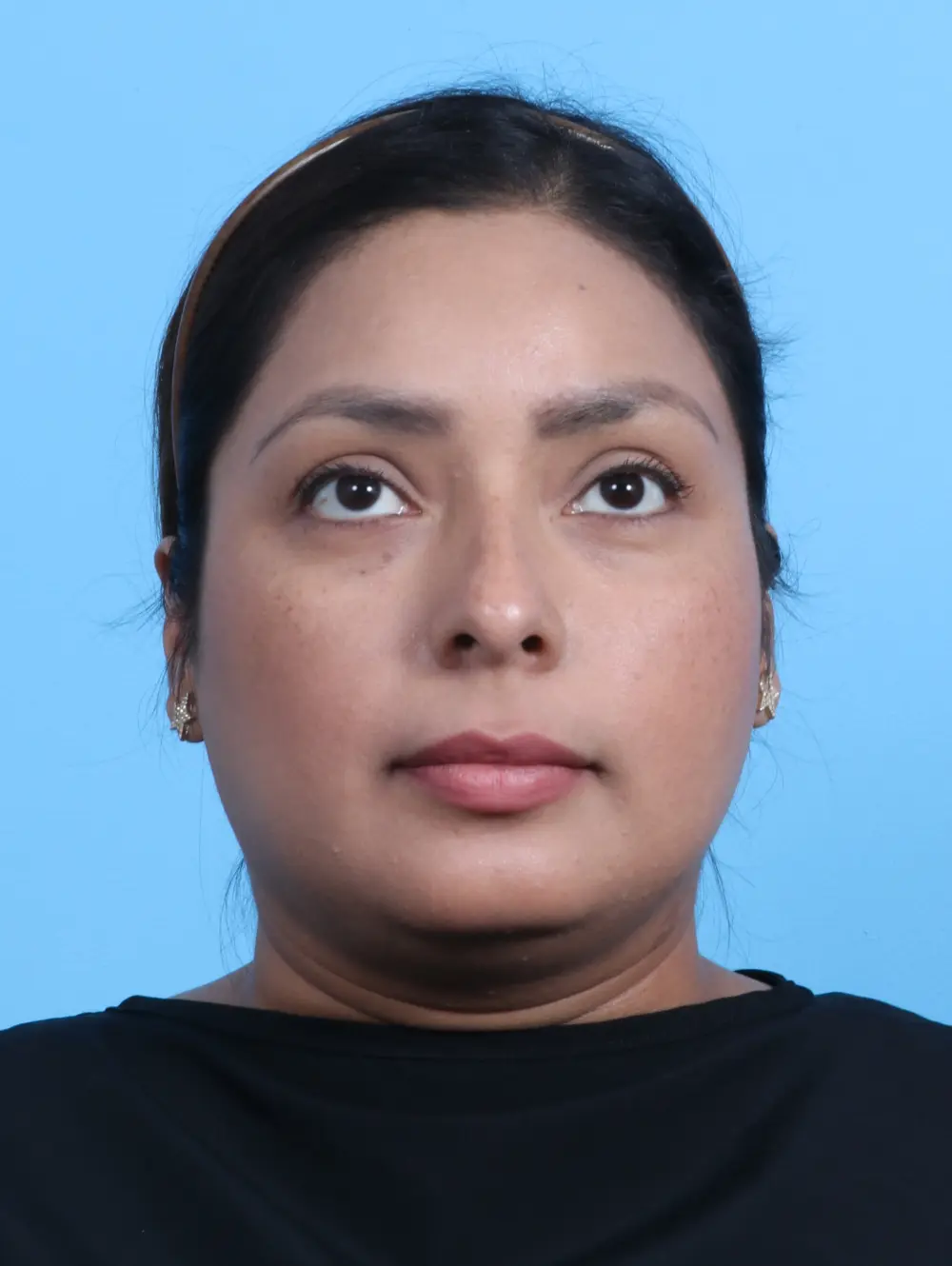 Rhinoplasty Patient Photo - Case 26494 - before view-2