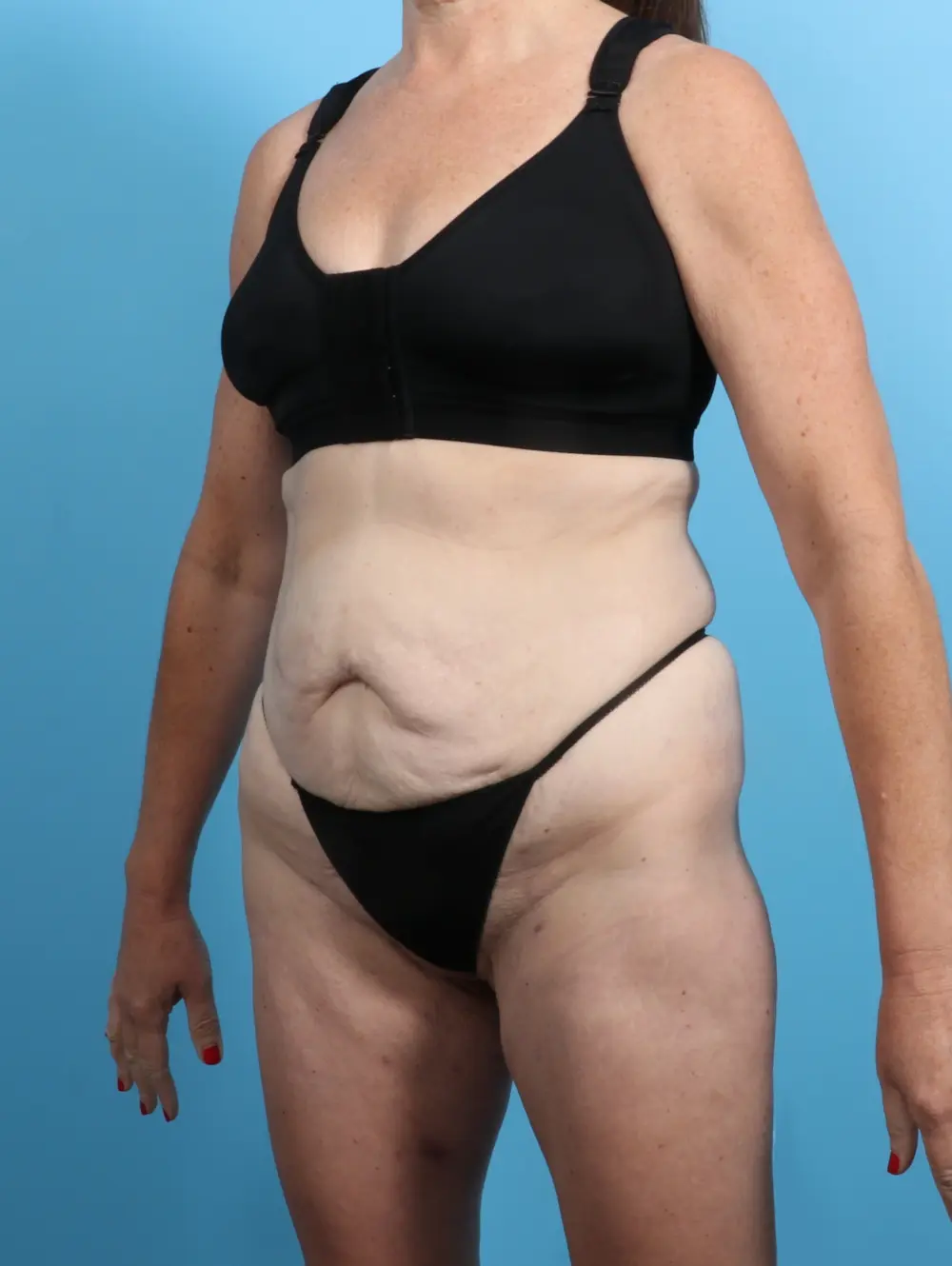 Tummy Tuck Patient Photo - Case 26502 - before view-1
