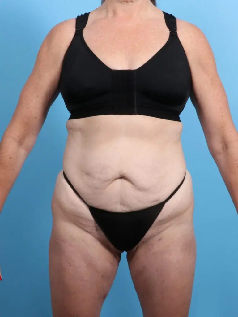 Tummy Tuck - Case 26502 - Before