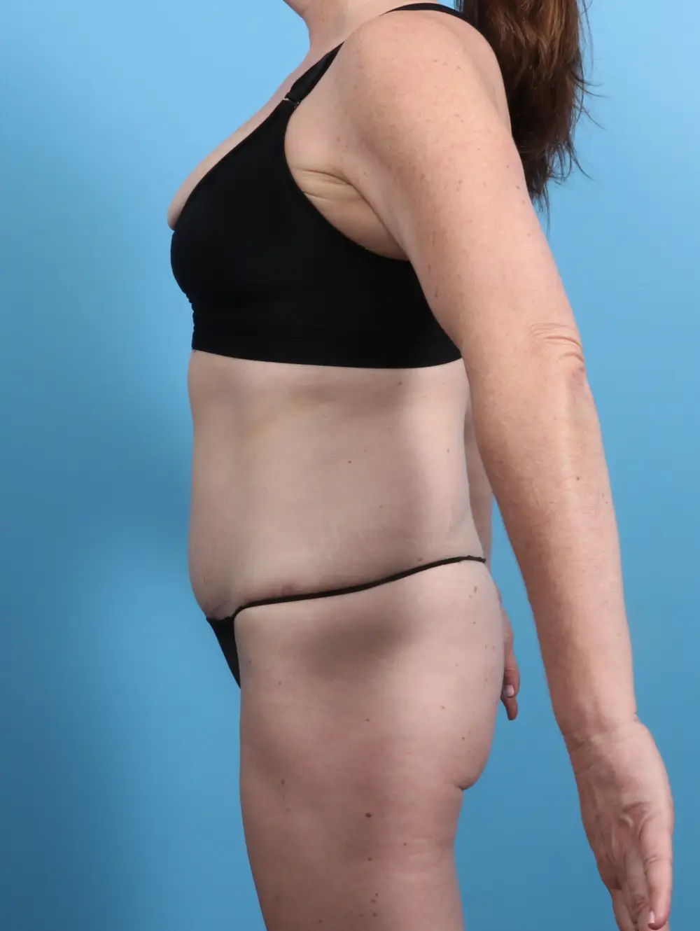Tummy Tuck Patient Photo - Case 26502 - after view-2