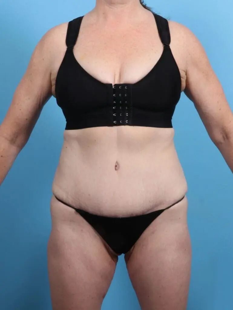 Tummy Tuck - Case 26502 - After