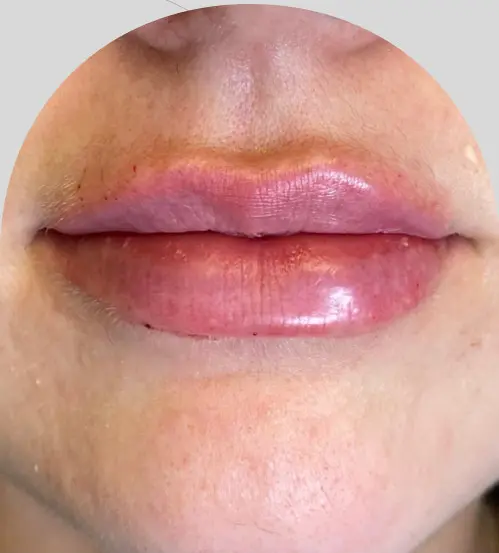 Lip Fillers - Case 26547 - After