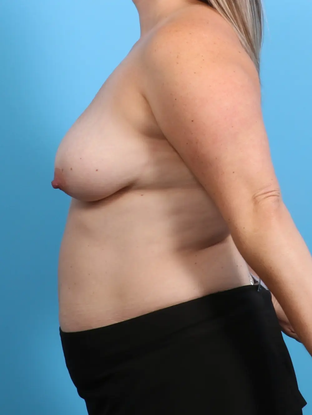 Breast Lift/Reduction with Implants Patient Photo - Case 26552 - before view-2