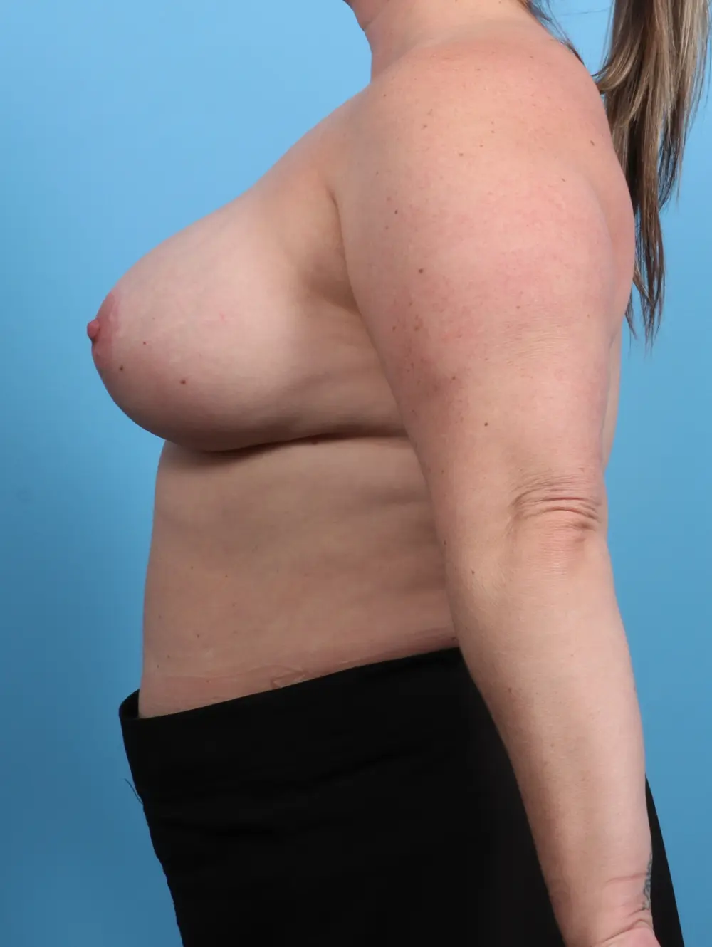 Breast Lift/Reduction with Implants Patient Photo - Case 26552 - after view-2