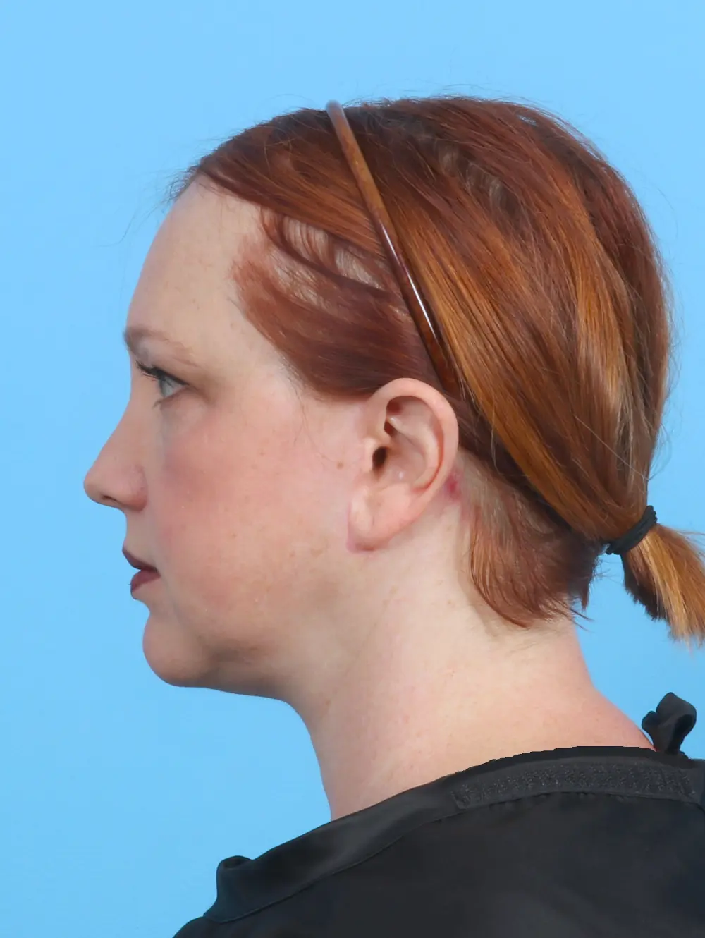 Facelift / Neck Lift Patient Photo - Case 26578 - after view-2