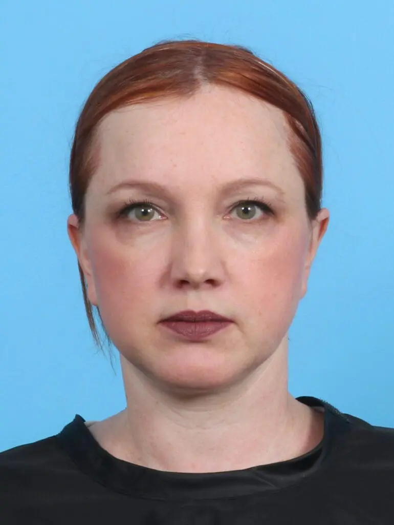 Facelift / Neck Lift - Case 26578 - After