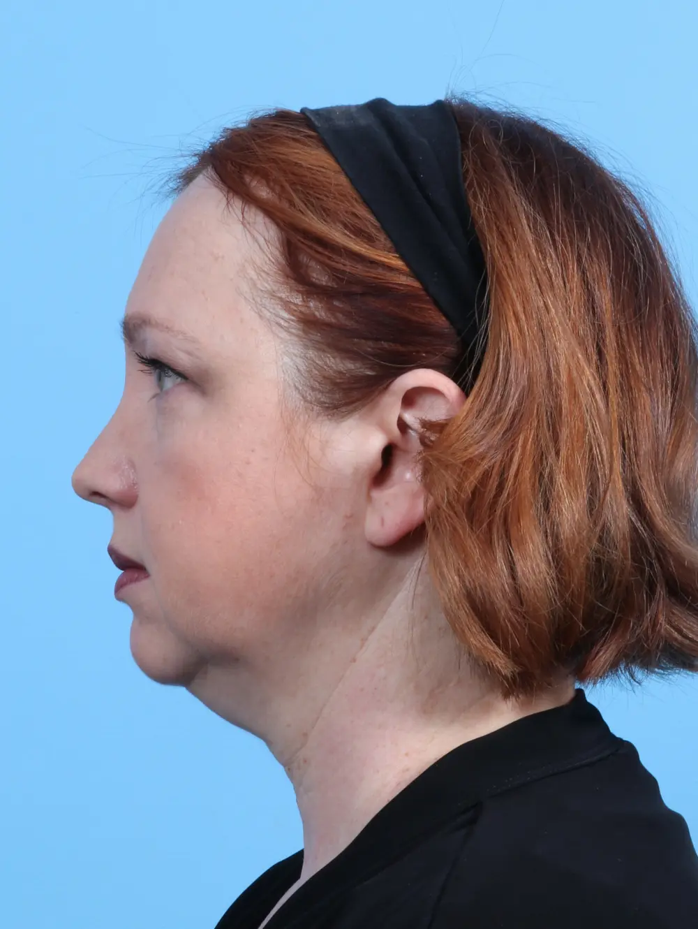 Facelift / Neck Lift Patient Photo - Case 26578 - before view-2