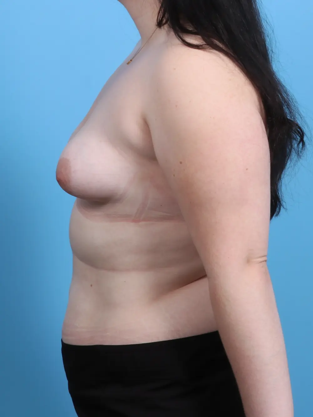 Breast Augmentation Patient Photo - Case 26604 - before view-2